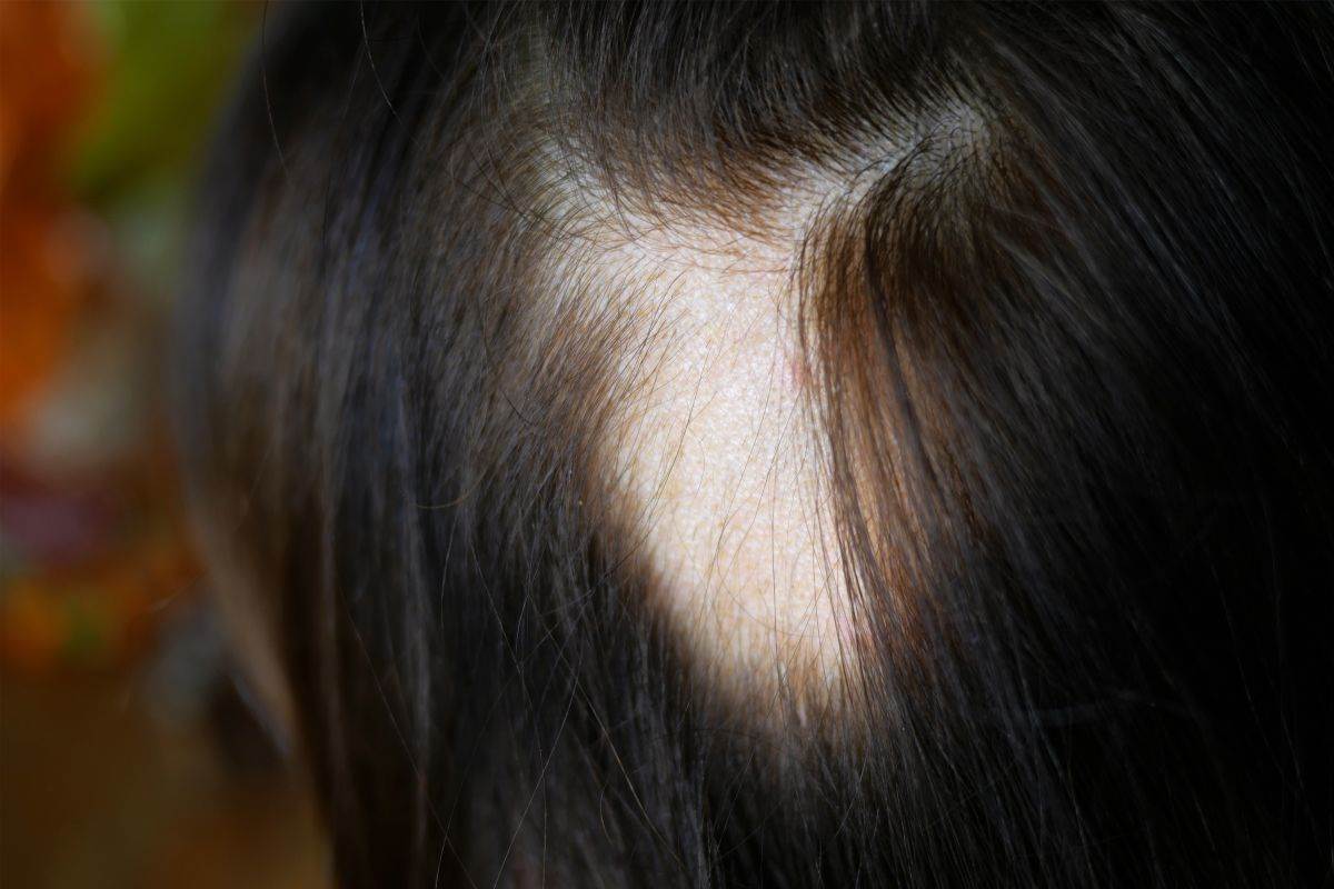 Alopecija 1504727846