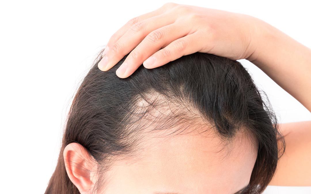 what to do about your thinning hair 1080x673 1