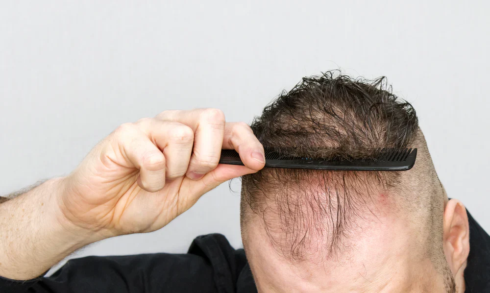 thinning hair solutions